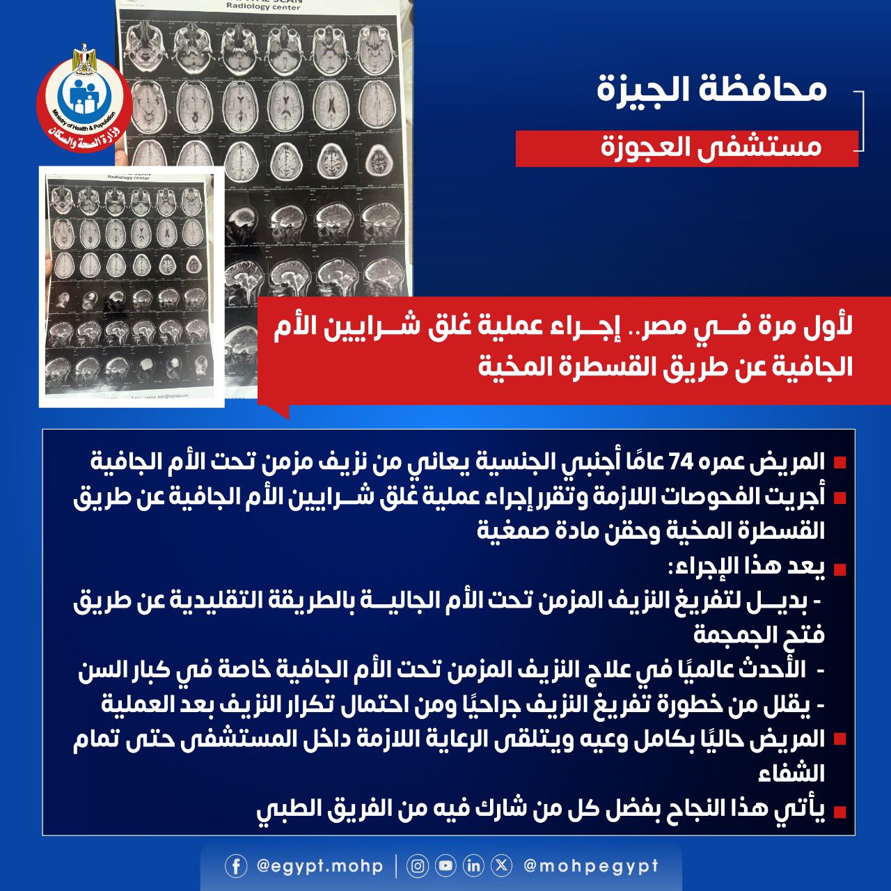 أول مرة في مصر إجراء عملية غلق شرايين الأم الجافية