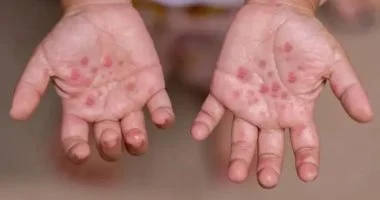 التعليم تكشف تفاصيل ظهور فيروس HFMD بين طلاب إحدى المدارس