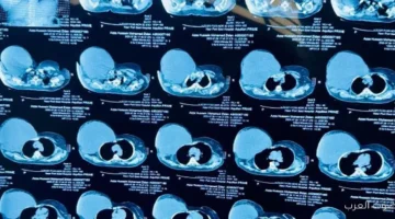 مريض يدفع 480 جنيه عشان يستأصل ورم وزنه 6 كيلو