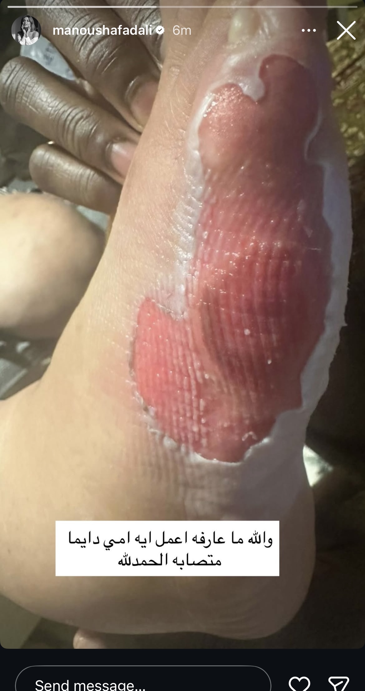 منة فضالي بتكشف عن إصابة والدتها بجرح في رجلها ومش