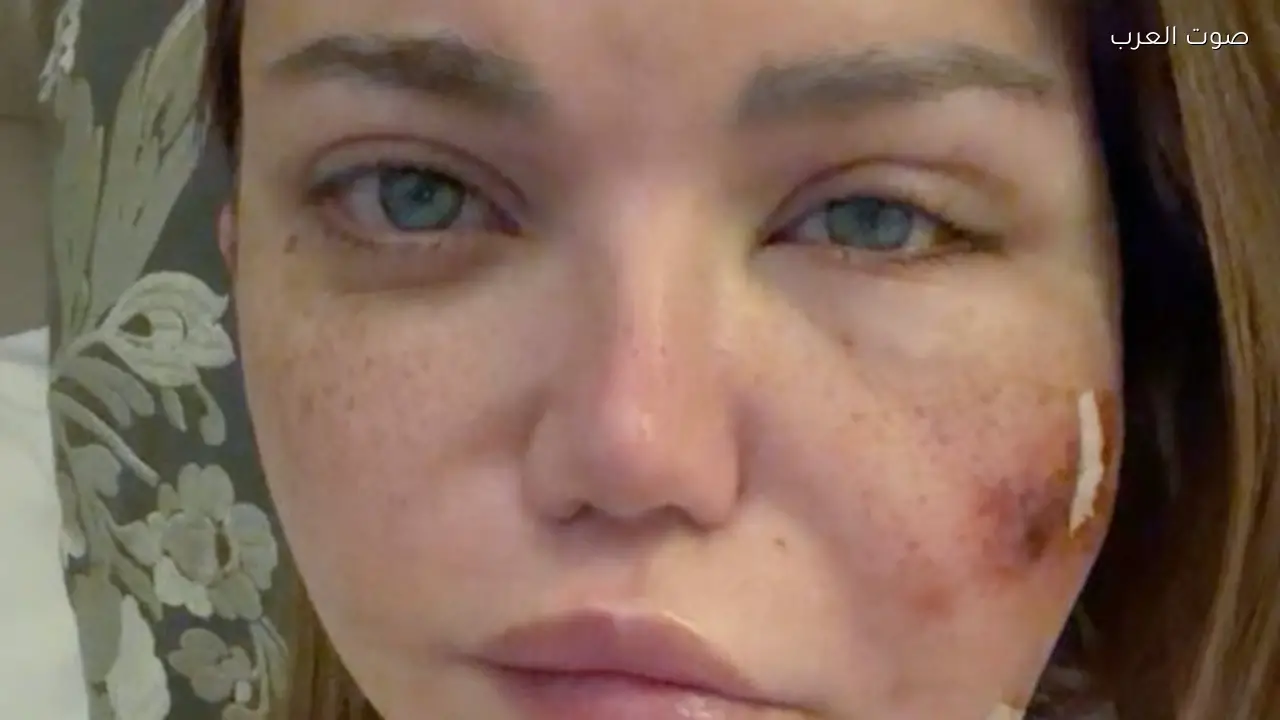 أسباب وأعراض خراجات الوجه عند ياسمين الخطيب