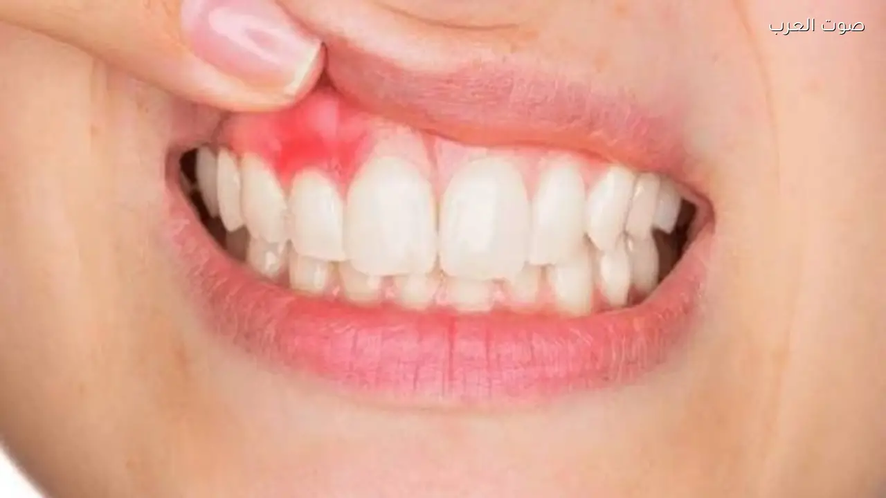 أفضل طرق علاج التهاب اللثة بفعالية