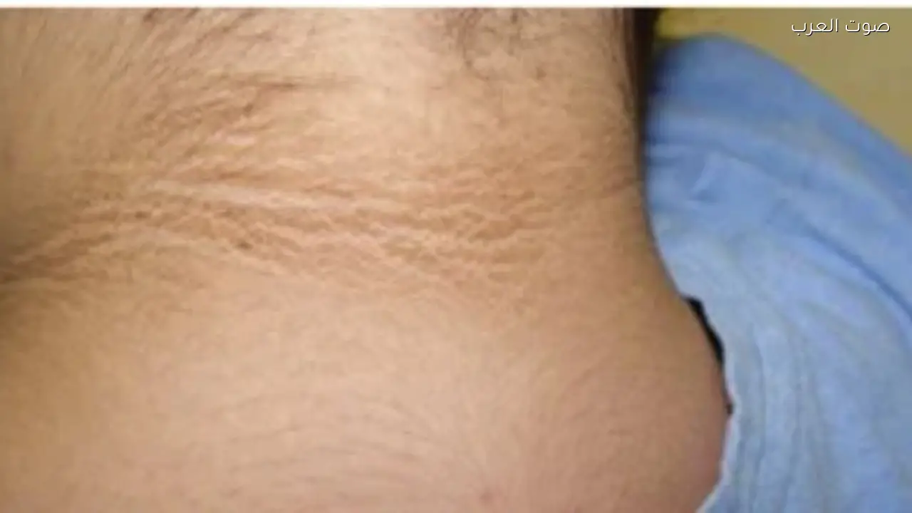 البقع الداكنة على الجلد قد تشير لمرض خطير