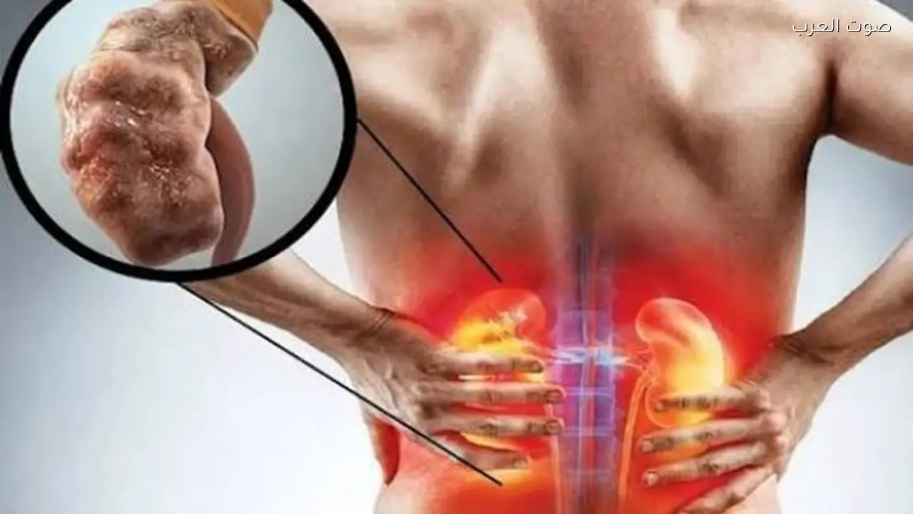تطور أمراض الكلى المزمنة ومراحلها ونصائح للسيطرة عليها