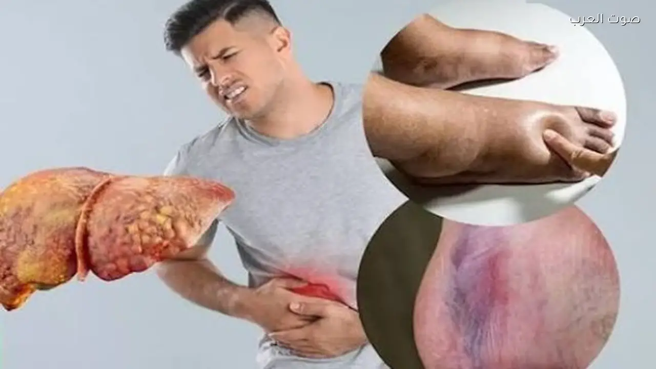 علامات الكبد الدهني وأعراضه تتطور دون إنذار مسبق