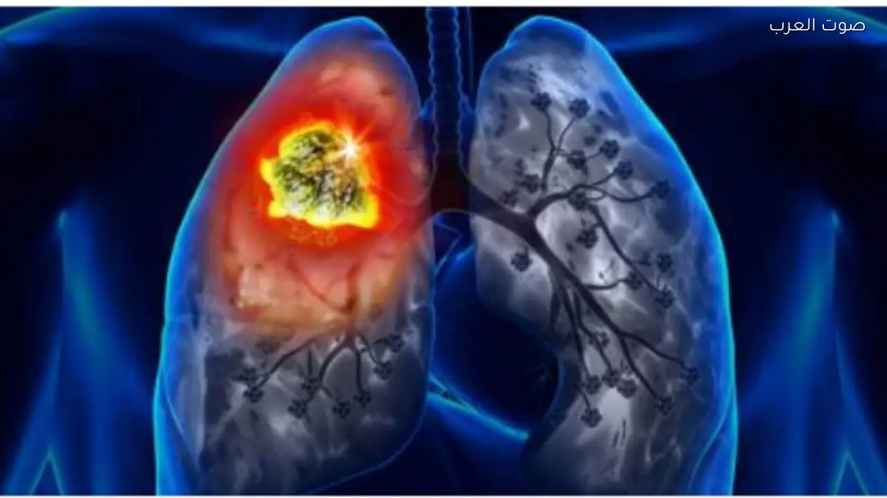 غير المدخنين معرضون للإصابة بسرطان الرئة معلومات أساسية تحتاج معرفتها