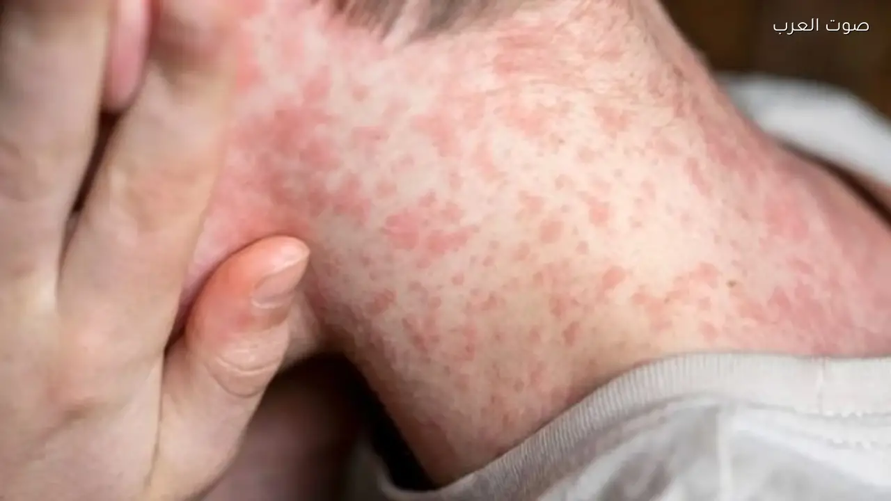 وفاة 15 طفلاً في إسرائيل جراء مرض معدي خطير