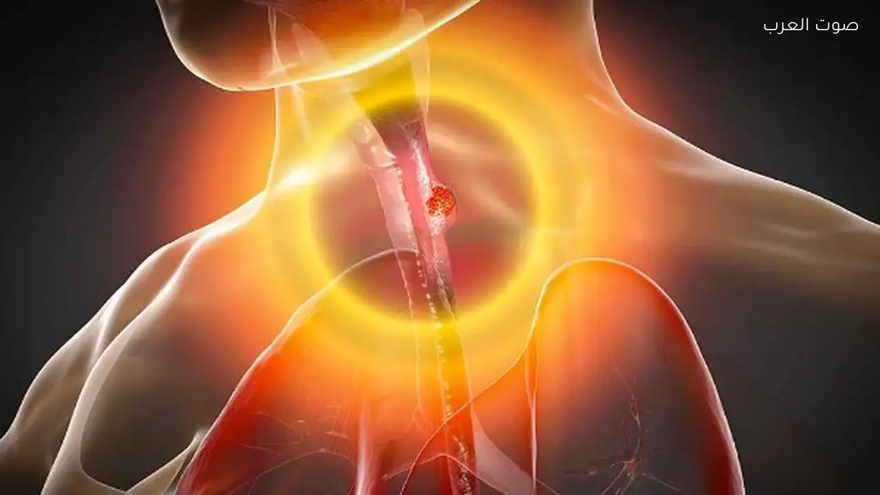 أعراض الارتجاع الحمضي وكيفية التعامل معه