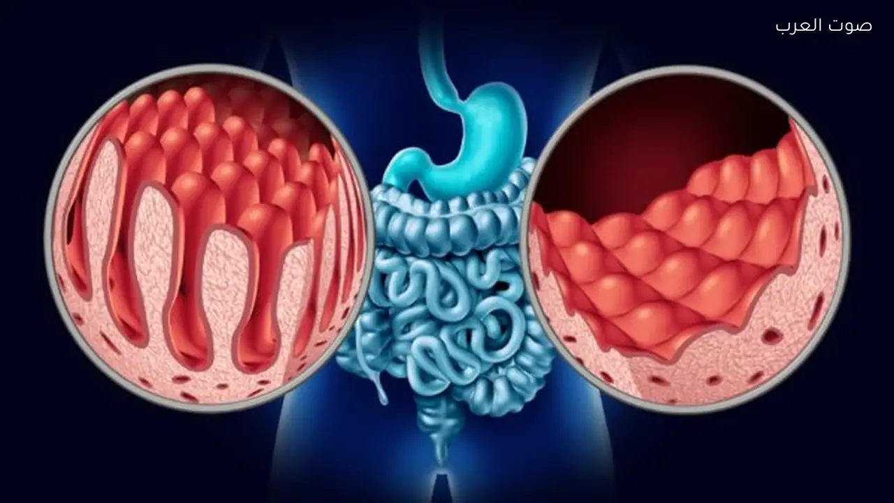 أعراض وأسباب مرض سيلياك وطرق علاجه الأساسية