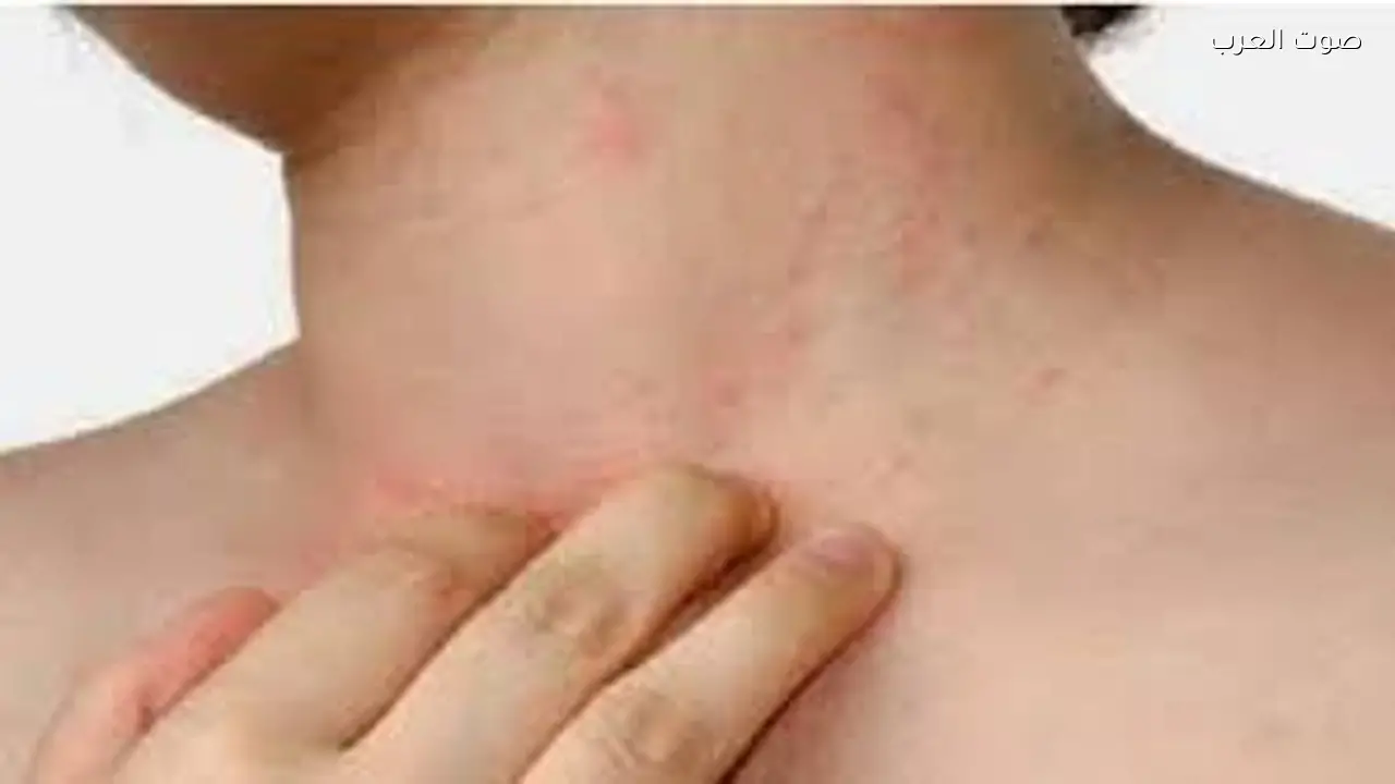 الصحة العالمية: 20% من حالات الدرن لا تُكتشف