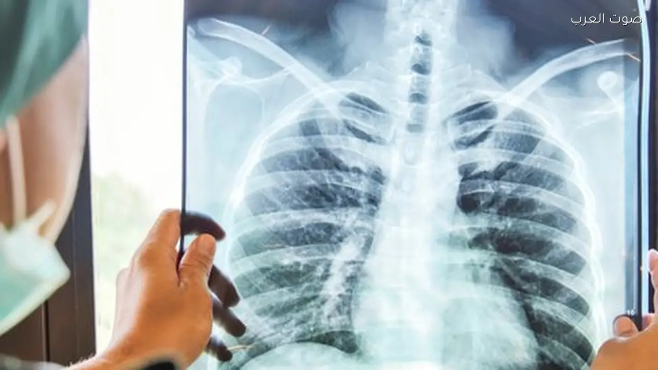 تحذير أمريكي من انتشار السل وأعراضه الرئيسية