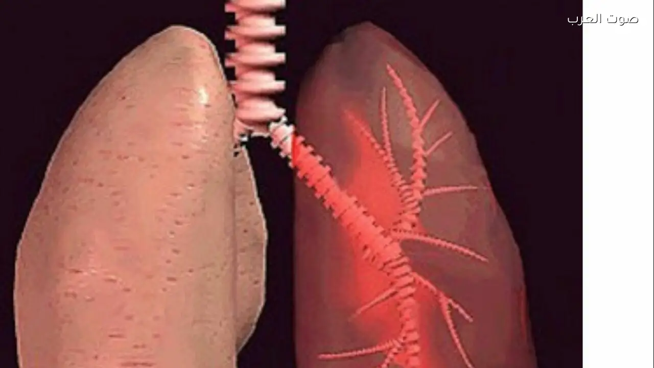 زيادة إصابات السل مستمرة منذ جائحة كورونا