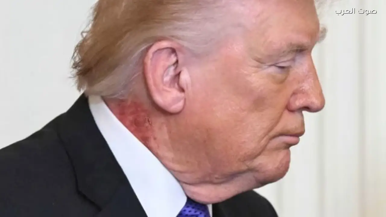 طبيب البيت الأبيض يوضح سبب طفح جلد ترامب على رقبته