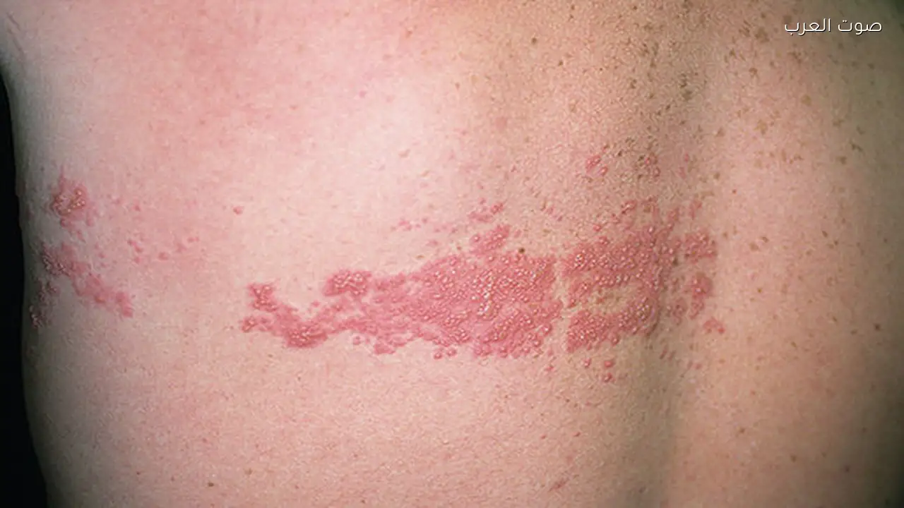 الحزام الناري مرض مؤلم يمكن الوقاية منه بالتوعية العالمية