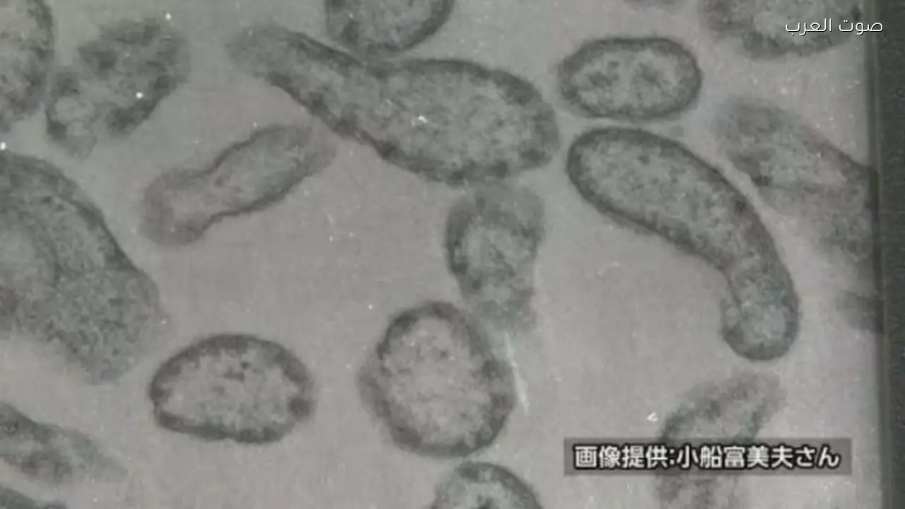 زيادة إصابات الحصبة في اليابان ودعوة لتطعيم الأطفال بسرعة