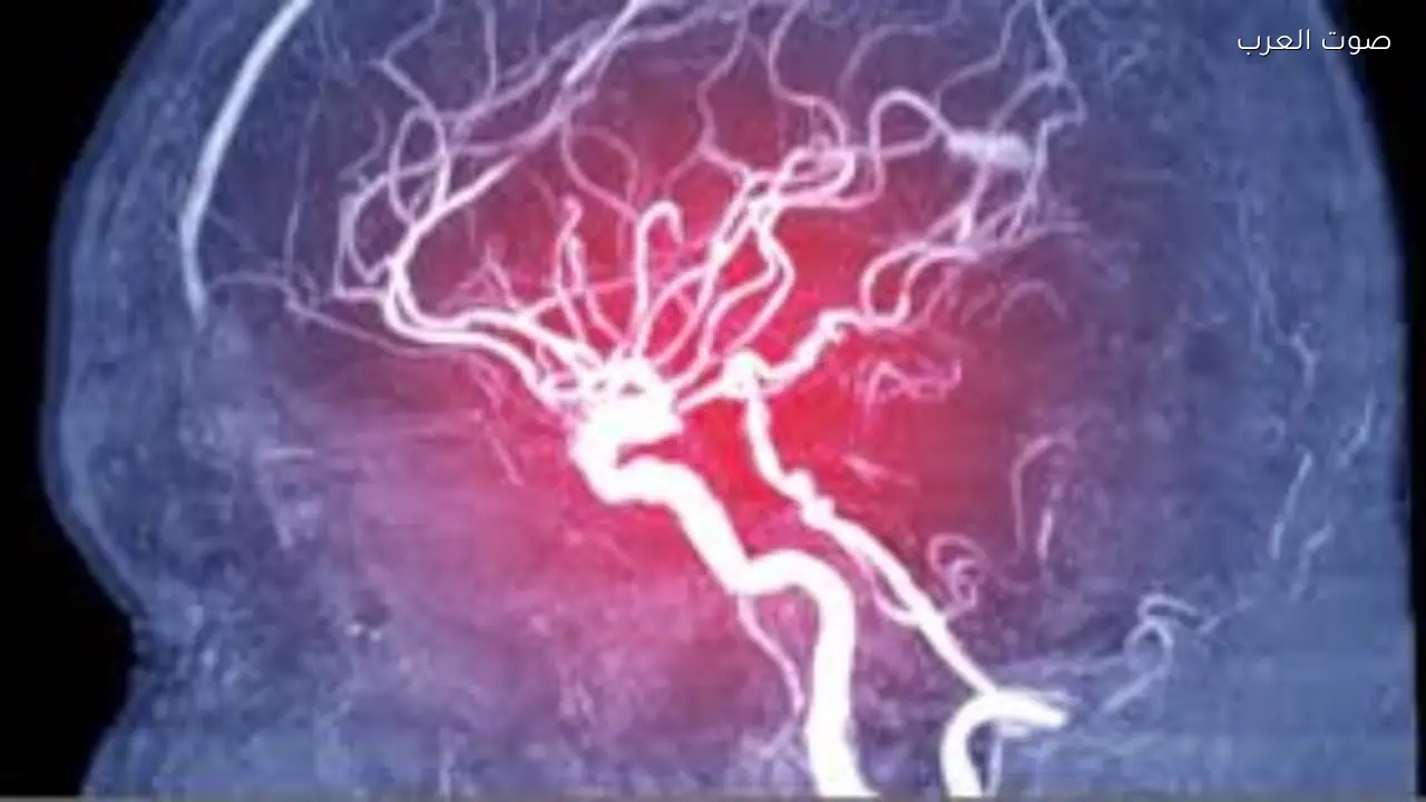 زيادة القسطرة المخية في المستشفيات التعليمية بنسبة 260%