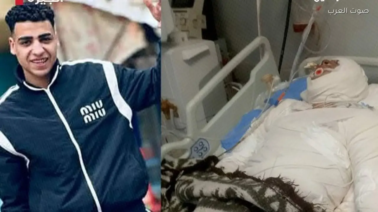 شاب يُحرق بالبنزين في بولاق الدكرور بسبب خلافات شخصية