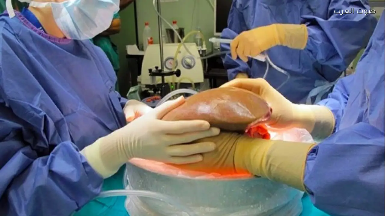 نجاح زراعة كبد باستخدام تقنيات الطب عن بُعد في مصر