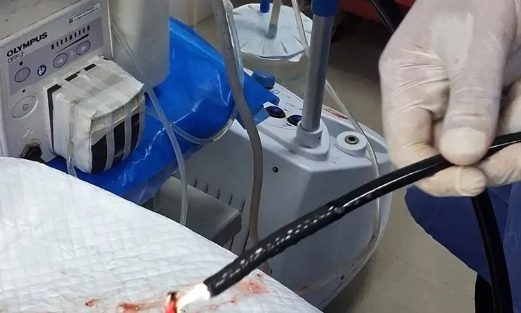 استخراج 100 مسمار وصامولة من معدة مريض بمستشفى جامعة بني سويف