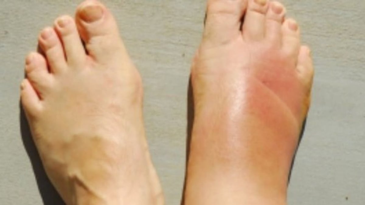 استشاري يوضح 3 أسباب للإصابة بالقدم السكري