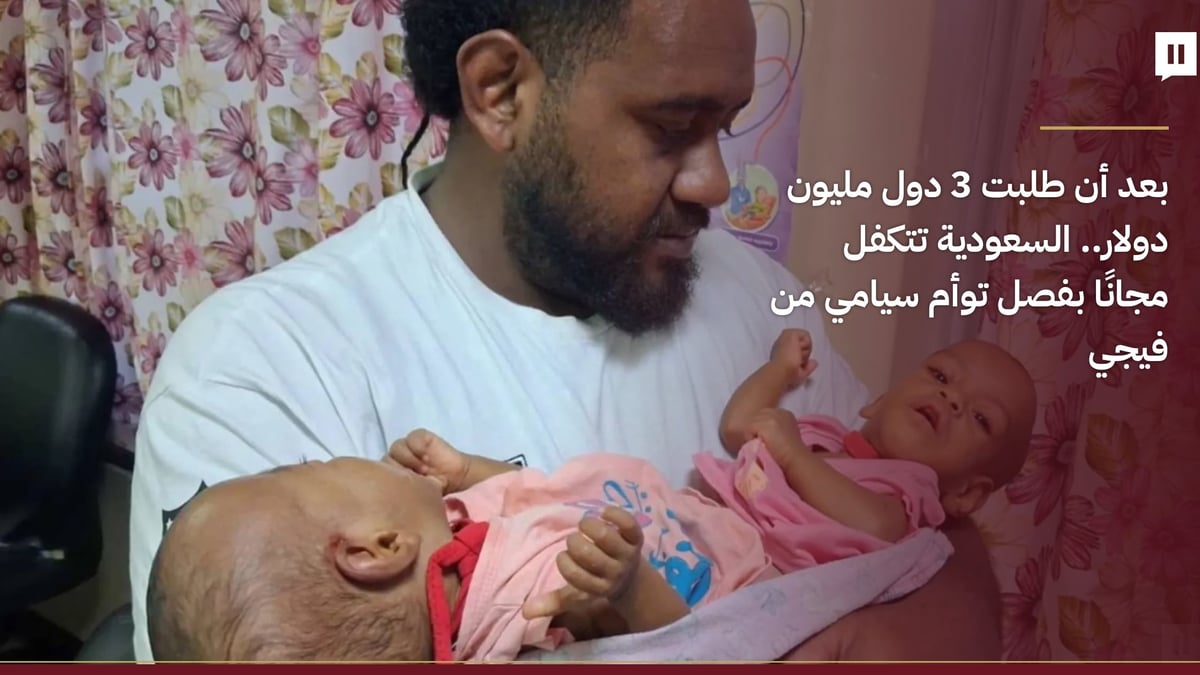 السعودية تتكفل بفصل توأم سيامي من فيجي مجانًا بعد طلب 3 دول مليون دولار