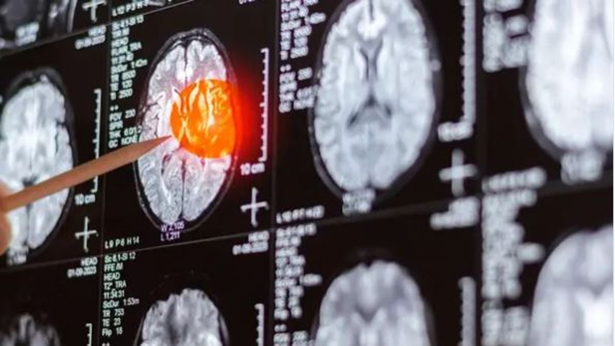 باحثون يكشفون عن نقطة ضعف في سرطان الدماغ تمنع عودته