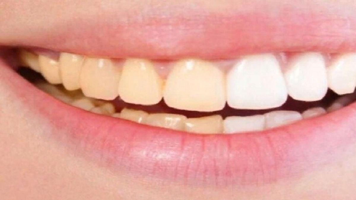 تغير لون الأسنان وطرق آمنة لاستعادة بياضها