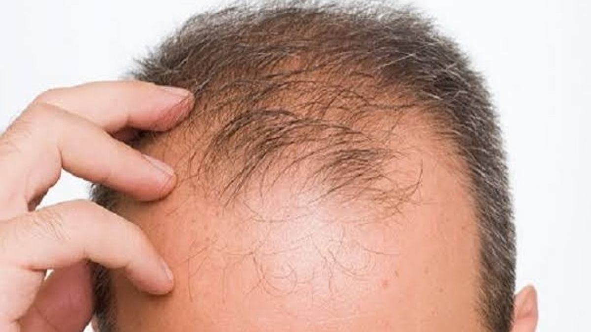 أدوية إنقاص الوزن تزيد من خطر تساقط الشعر عند الرجال