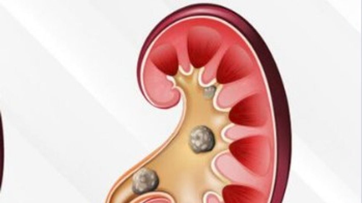 استشاري يوضح 6 أسباب لتكون حصوات الكلى